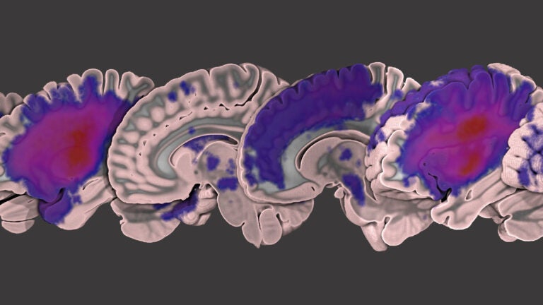 brain lesions
