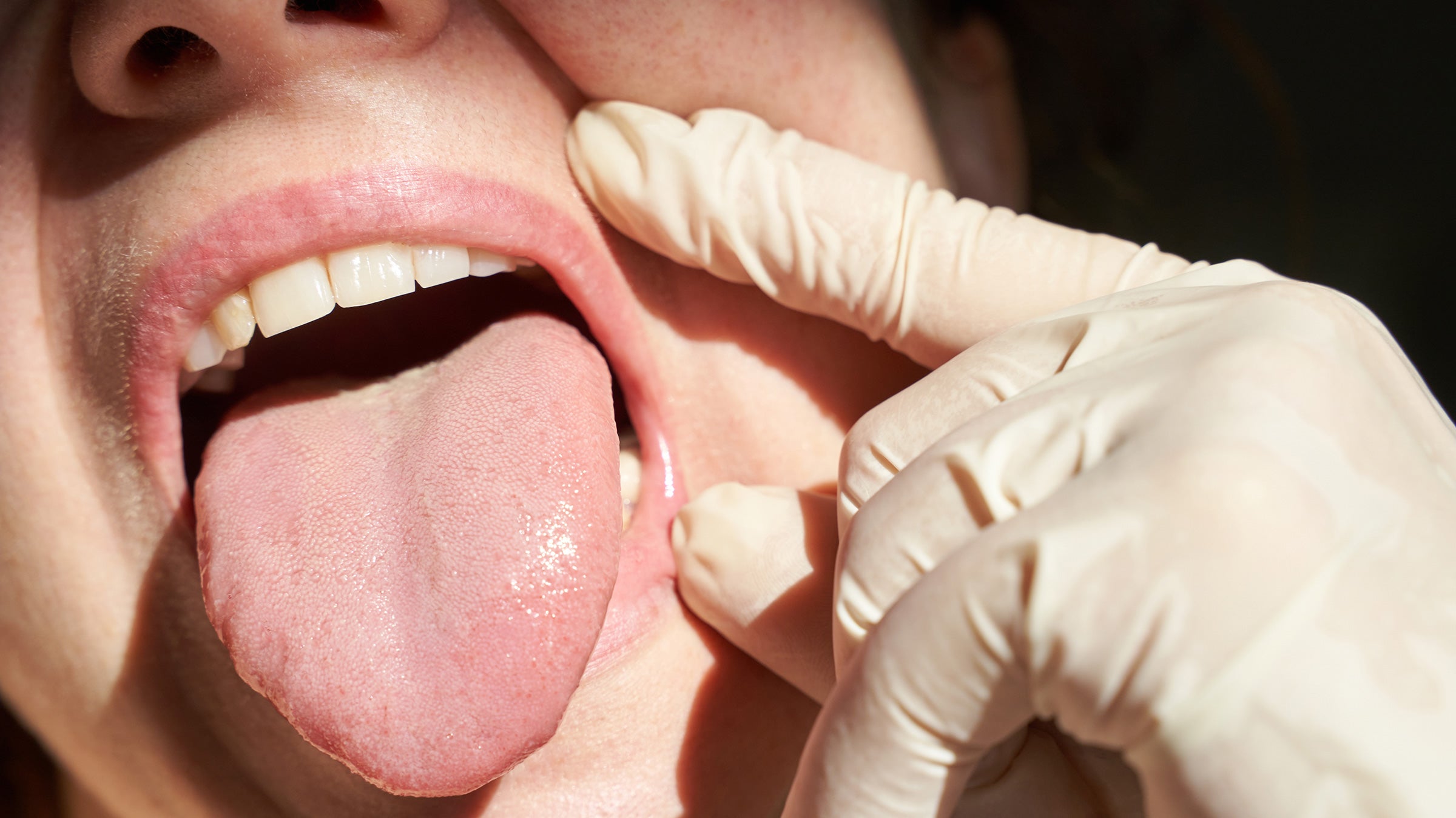 Woman-Tongue-Stuck-Out-Oral-Cancer_uscn_0977